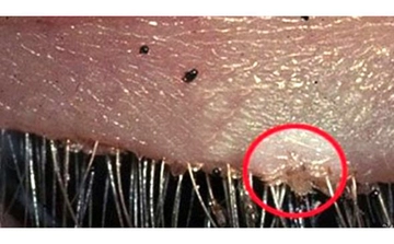 Kirpik Biti Belirtileri ve Tedavisi Kirpik Biti Belirtileri ve Tedavisi